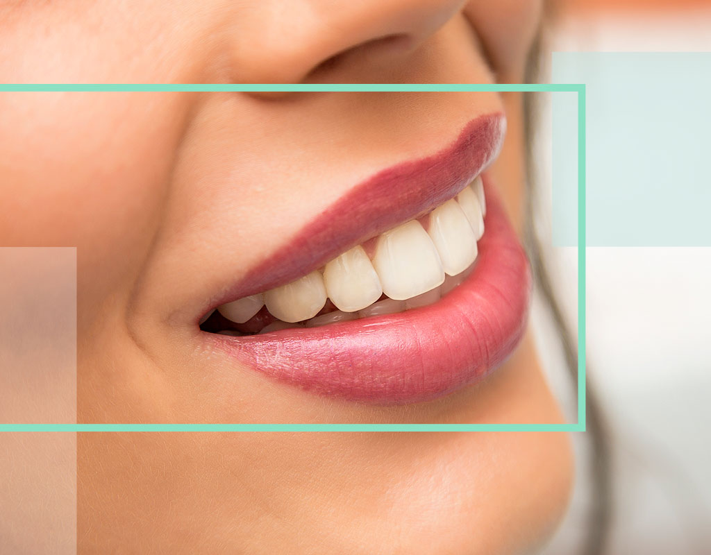 Diseño de sonrisa con carillas dentales Diseño de sonrisa con carillas dentales