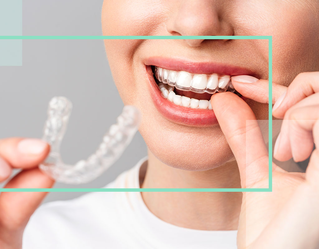 Ortodoncia invisible invisalign collado villalba